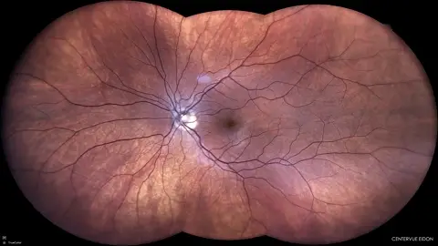 Retina photo example